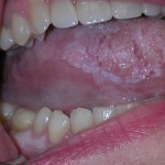 cáncer de boca